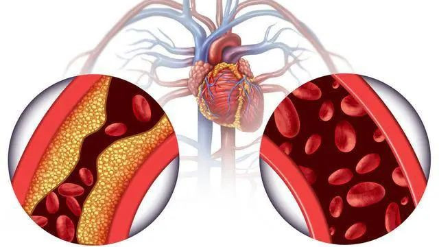 牙齿|心脑血管病越来越多，哪些因素对血管不利？保护血管的方法请收下
