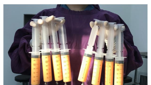 脂肪填充之后为什么不肿，但是一周之后特别肿？