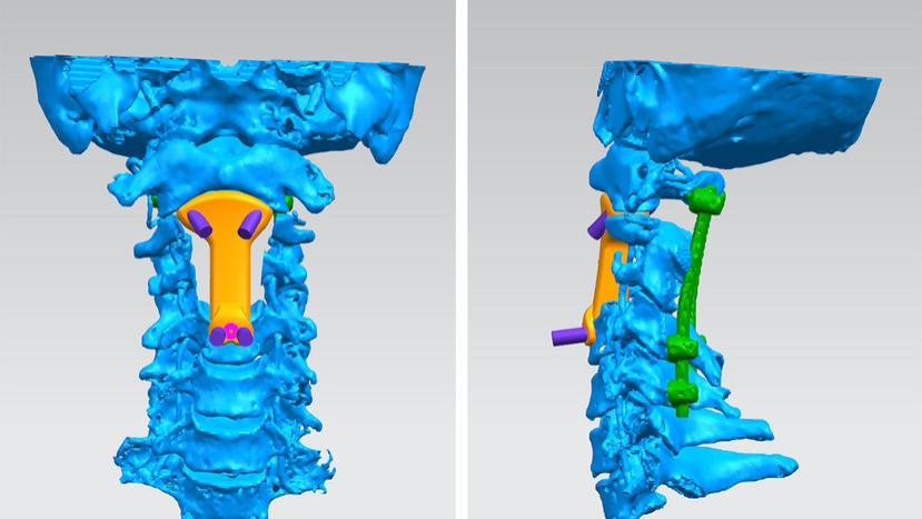 发病率仅为1/100万！立“椎”之地，协和专家精准拆除颈髓肿瘤“起爆器”
