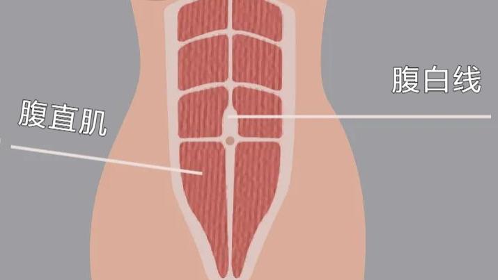 |被“掰开”的腹肌，腹直肌分离怎么办？3个动作让你自我检测