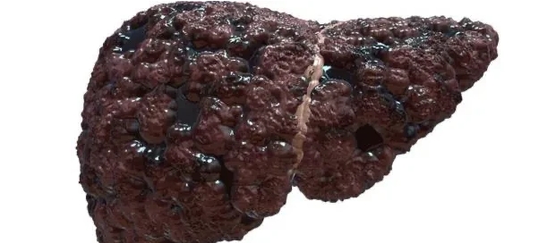 肝脏只有巴掌大小，但别小看它，它是人体重要的解毒器官，无法被取代！【肝不好，身体