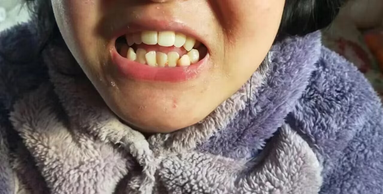 现在的人真能折腾，妯娌家的孙女17岁了，上下门牙有点不整齐，看见别人整牙，她也嚷