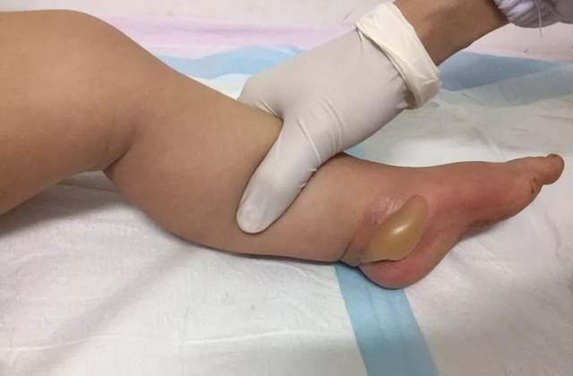 而依依妈妈在家里面直接给孩子用流动的水来降温，就会让孩子被烫伤的部
