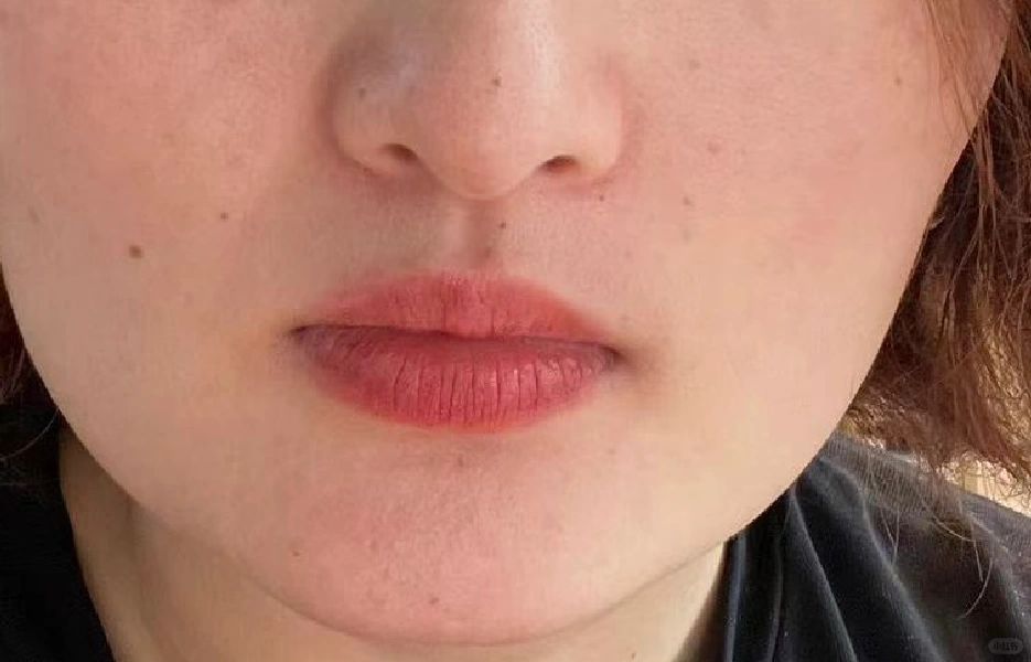 2024终于鼓足勇气了
一直都喜欢厚唇，2024终于实现了。

前后对比图片|
