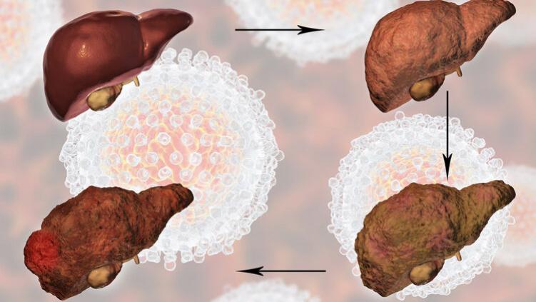 全球近一半肝癌在中国，提醒：家中的这4种食物，尽早撤下餐桌！