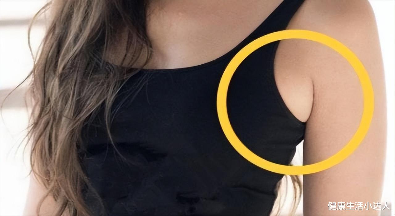 副乳到底是啥? 医生提醒: 不只影响美观, 2种情况要手术