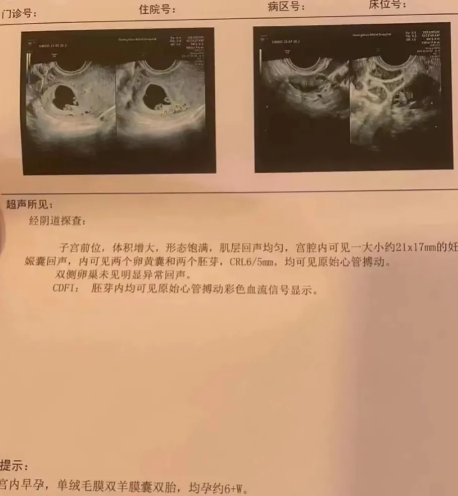 我做的是三代试管，选的是男宝宝，移了一个胚胎，竟然同卵分裂成双胞胎了。