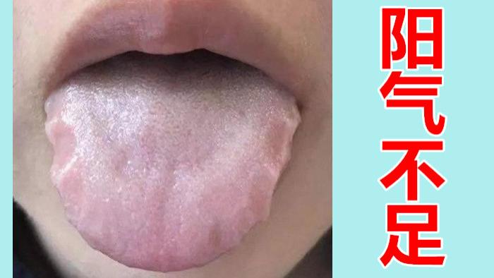 阳气不足舌先知！快来对照自己的舌头，看看自己阳虚到了哪一级？