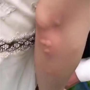 蚊子为什么盯着她咬啊？