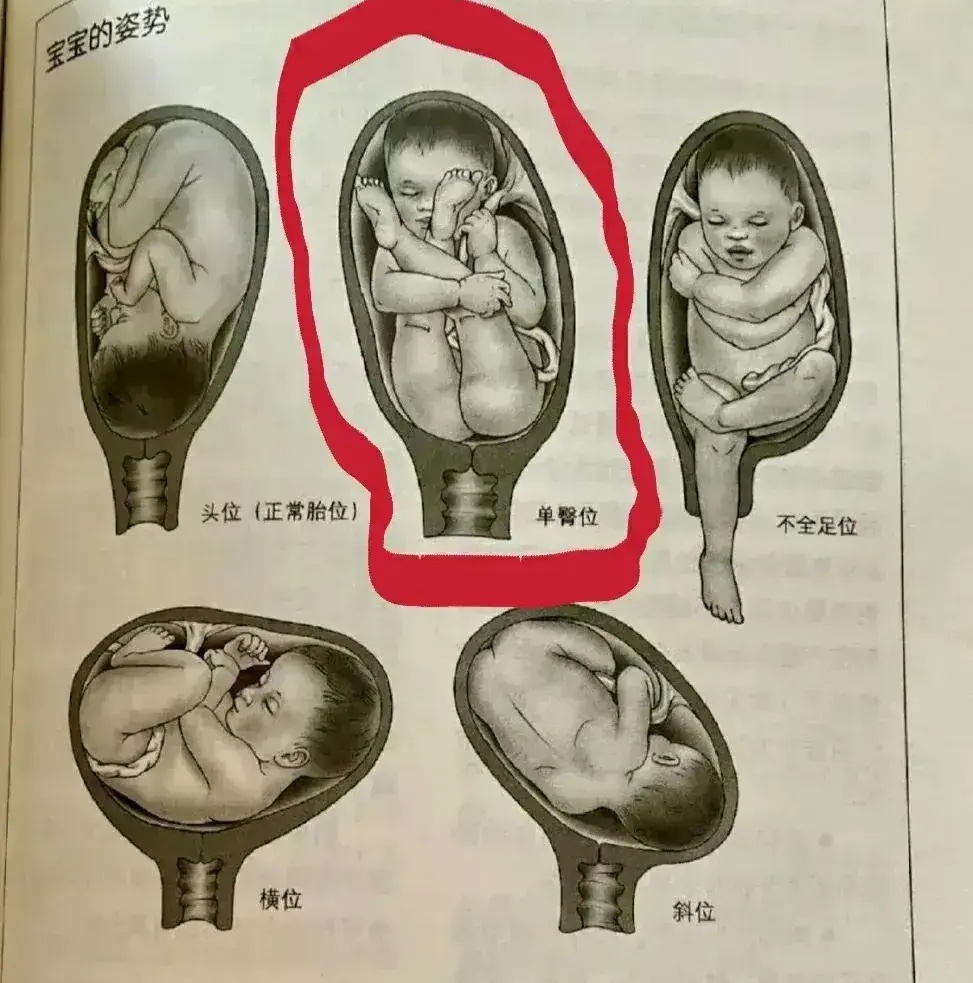 以前的那些阿婆老是说生子产妇半条命，一脚在人间一脚踩进棺材里边，看看那些胎位异常