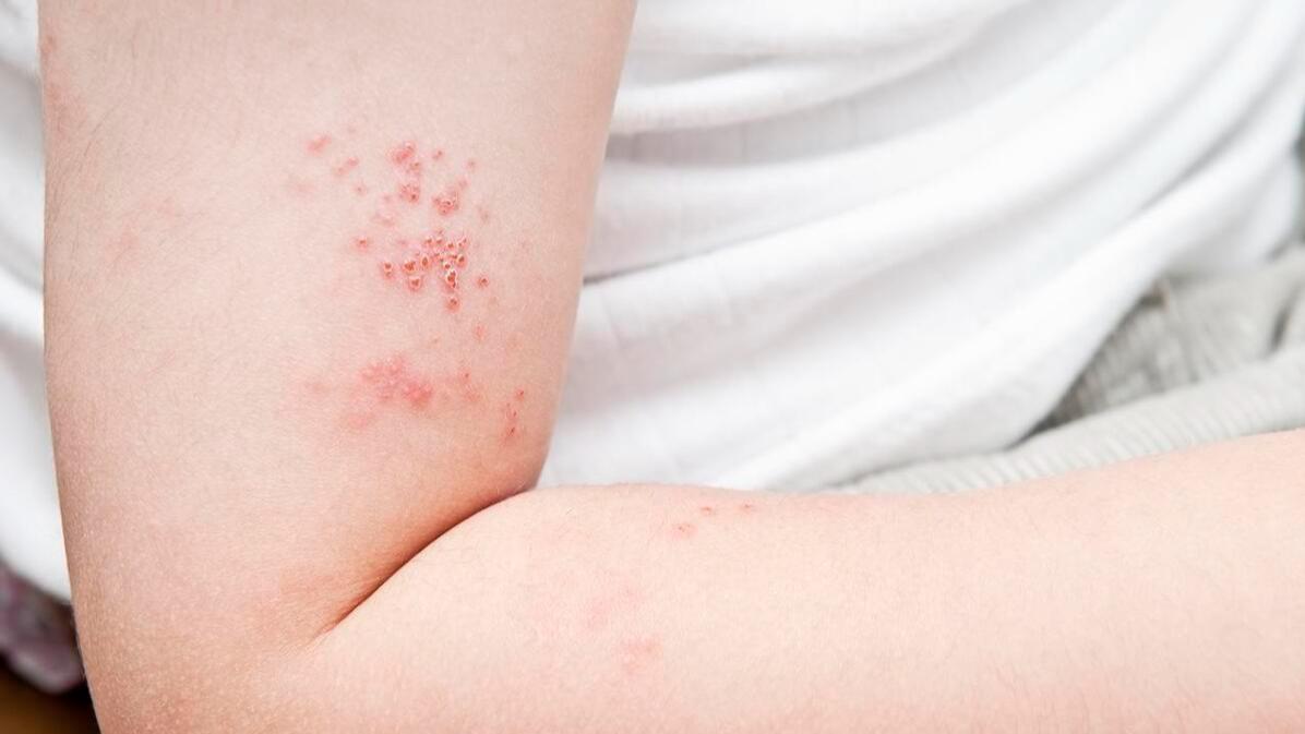 带状疱疹长什么样子，长一圈就会死人吗？皮肤科医生来告诉你