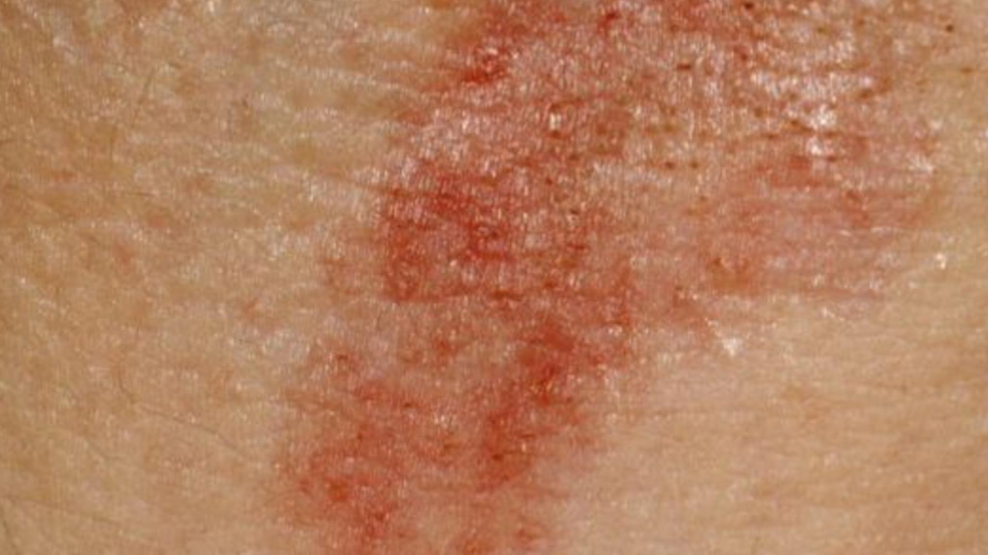 |孩子出现皮疹，医生提醒：这些情况需要及时就诊