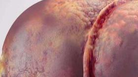 脂肪肝别害怕，做好这几点，还是可以逆转的。