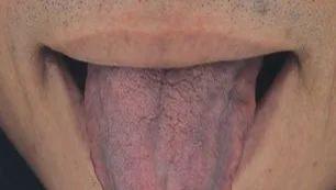 舌上有这两条线，当心肝有病变