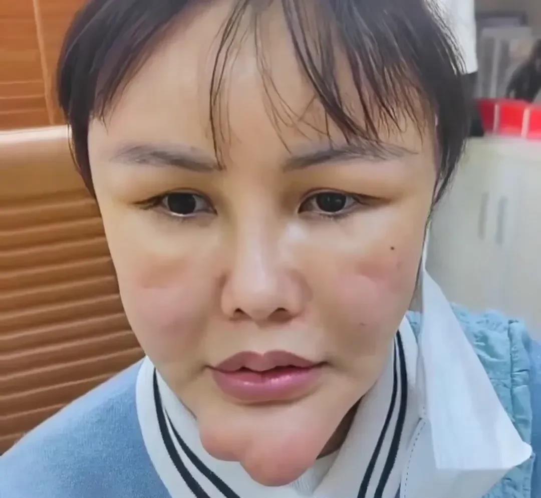 这次可咋整啊？？花5万整成这样……做完之后没有回头路。生长因子永远不要去碰。昨天