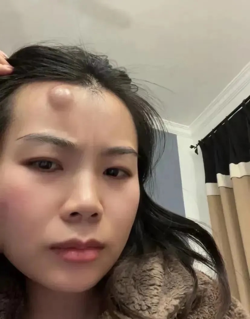 姐妹们，急急急！
中午还约了相亲对象见面，没想到刚才上厕所撞了一下，现在头上这么