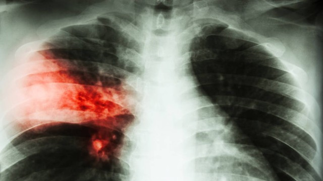 肺炎支原体会引起什么并发症？你需要注意这些危险信号