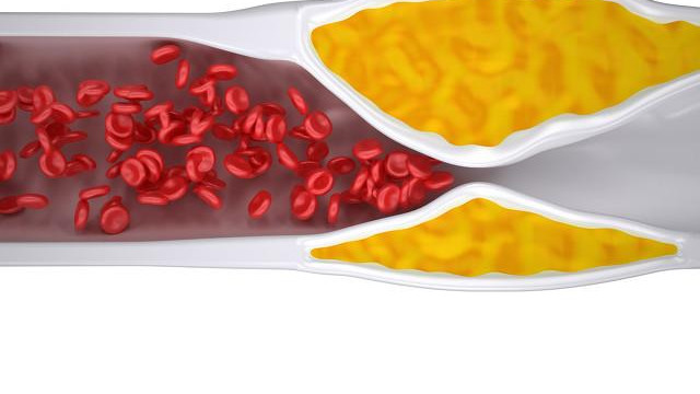 血管堵塞“根源”已找到，并非肥肉，而是它，别再视而不见了