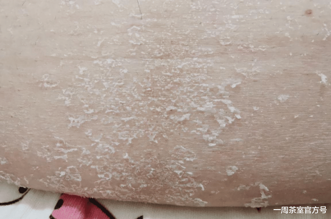 冬天脱衣服时总会有很多皮屑掉落? 医生提醒: 别大意! 身体乳没有用, 该补充维生素了!