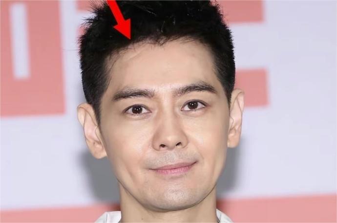林志颖在台北出席了一场公益活动。他首次露出了车祸后留下的脸部伤疤，并承认自己的视