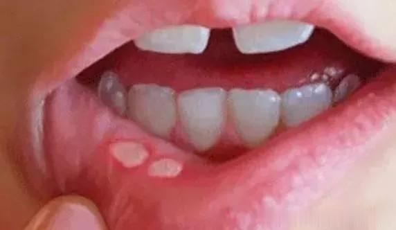 与口腔溃疡斗智斗勇的这些年, 我终于总结出这个行之有效的方法