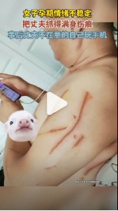 女子孕期情绪不稳定，把丈夫抓得满身伤痕，事后丈夫不在意的自己玩手机。