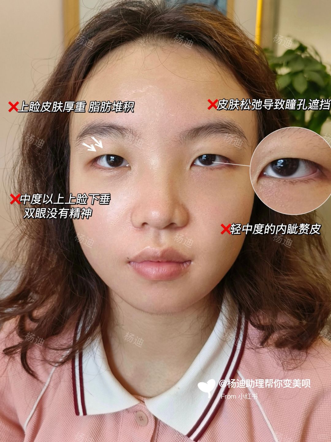 左滑👉上睑X垂爆改灵动双眼皮👀
去年五月刚刚高考完的宝宝，她整体的基础不算好