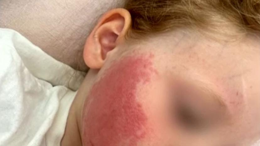 澳洲男孩使用防晒霜后出现不良反应，面部又红又痒