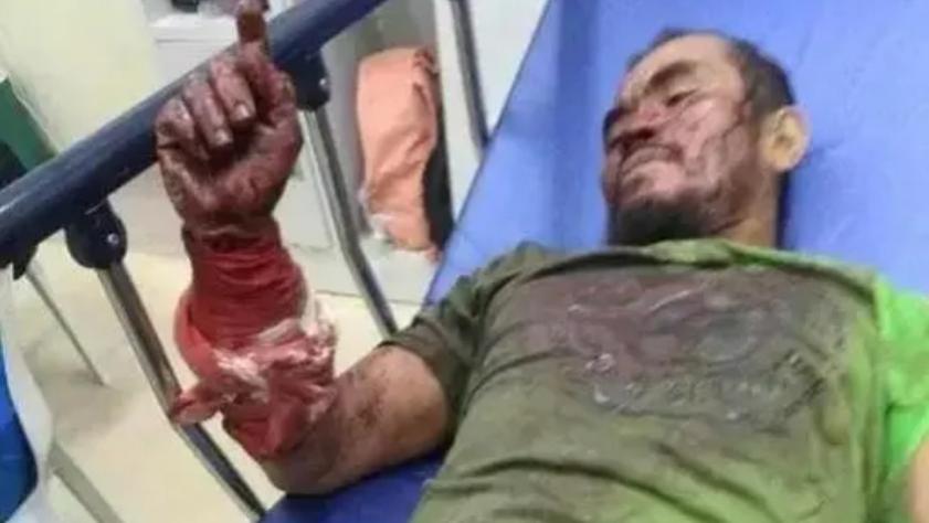 菲律宾男子咬死3米巨蟒：遭蟒蛇咬伤缠身后，他狠咬蛇脖子自救