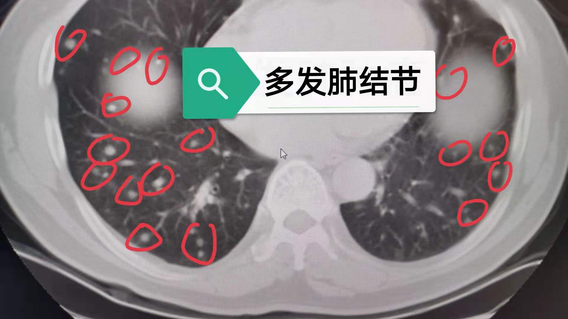 发现557个结节! 什么原因引起的? 和肺癌有关系吗? 如何治疗?