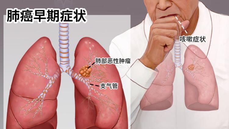 为什么中国越来越多人得肺癌？实话说：除了抽烟，还有这4大诱因
