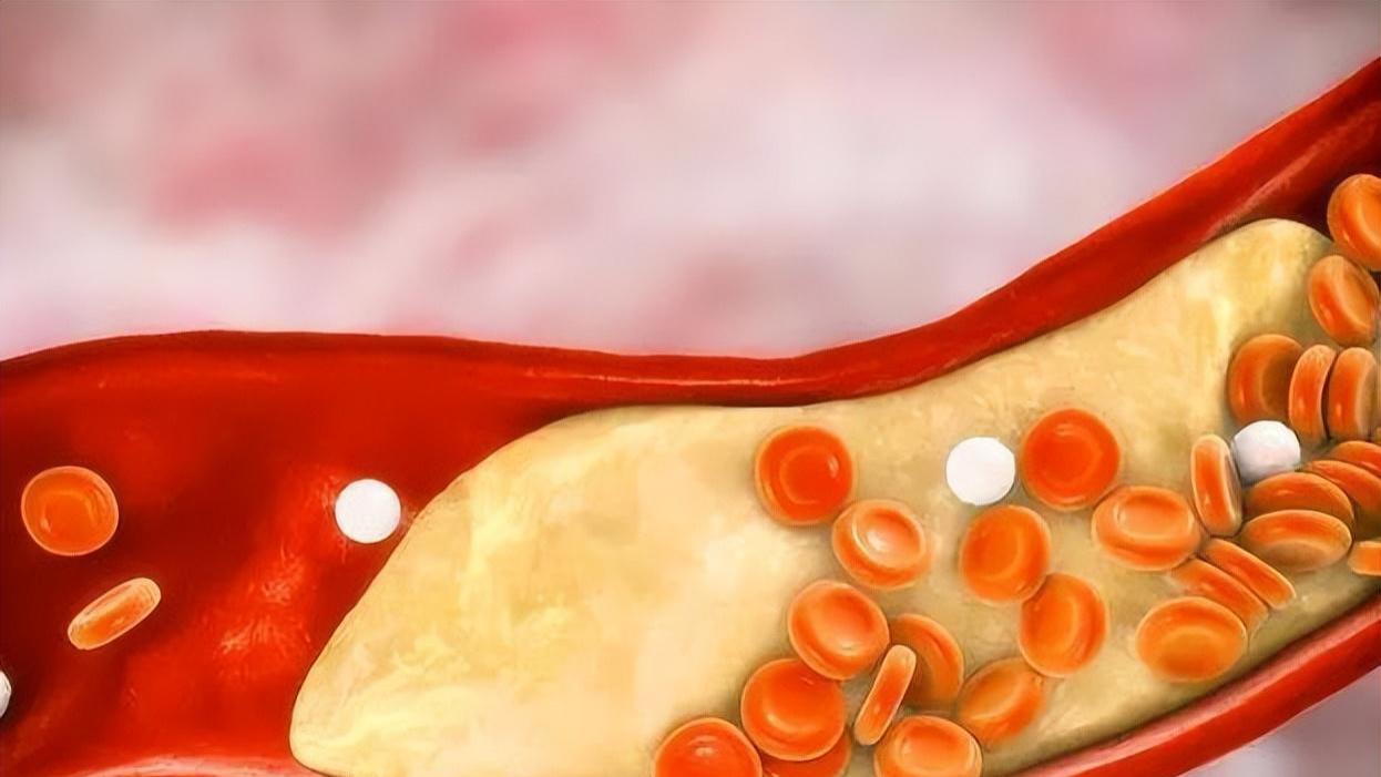 中老年人|“胆固醇大户”被揪出，医生建议：能不吃就不吃，别再傻傻去吃