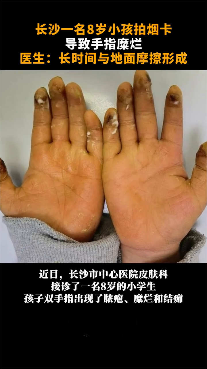 8 岁小学生沉迷拍烟卡，手指溃烂