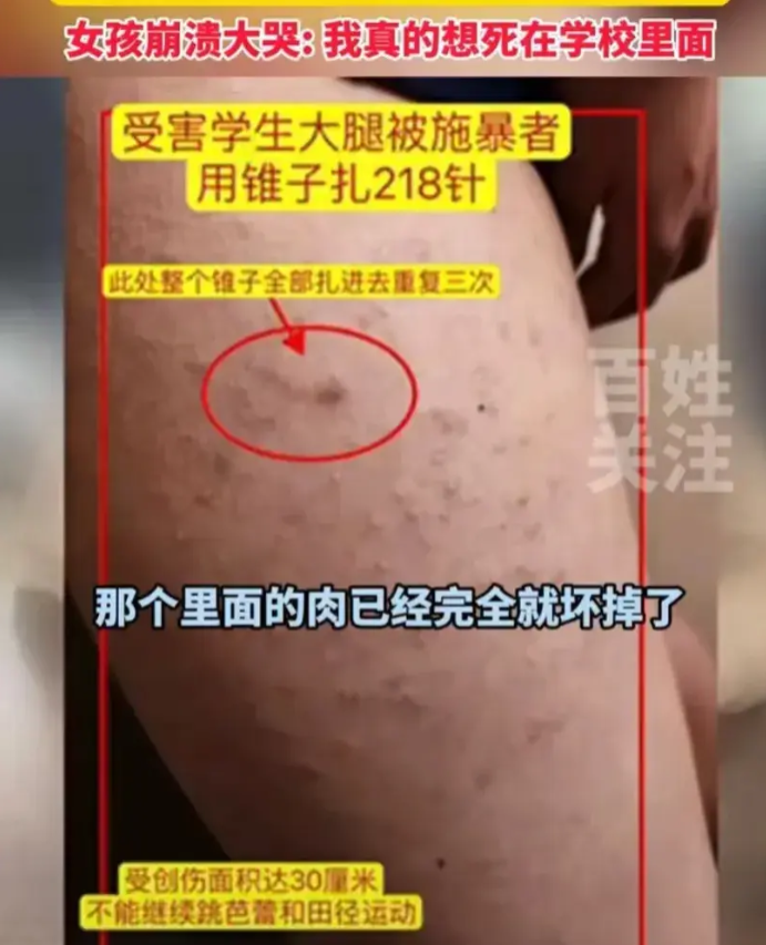 “我真的想死在学校里面！”山东济南，一小学女生被男同桌扎218针！针头8厘米全扎