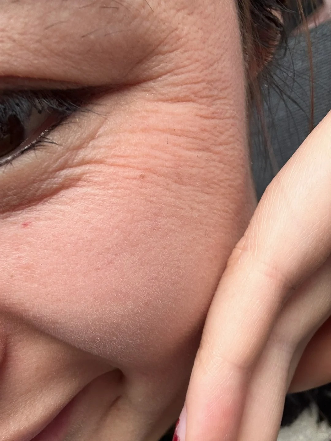 我才25就老成这样了？
以前是油皮，近一年没用洗面奶才晋升到干皮，但是这些纹怎么