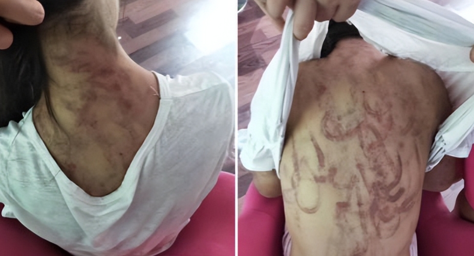 福建龙岩，一小学校长发现7岁女生身上有诸多於痕，精神状态极差，怀疑该女生被人性侵