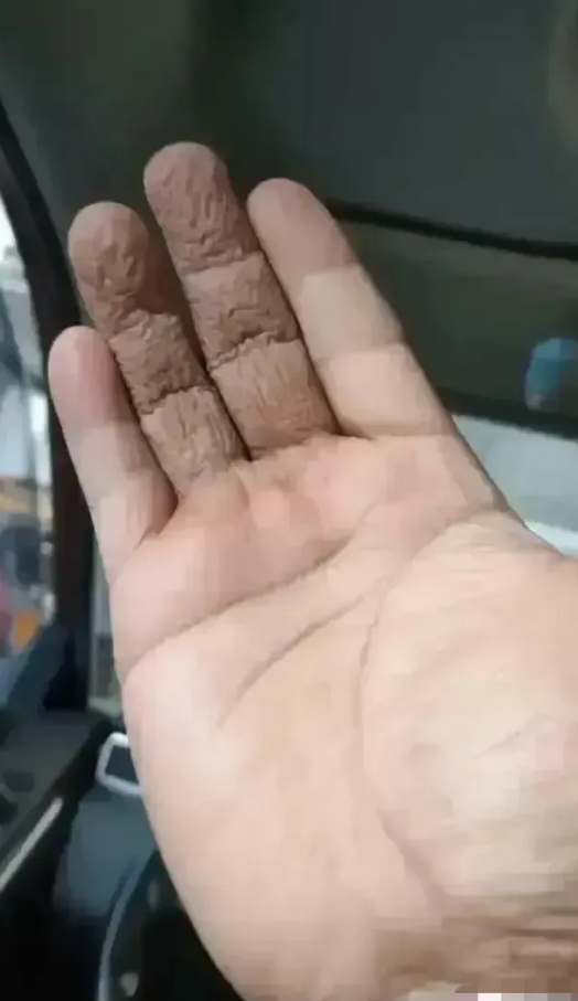 朋友们！这手要怎么救啊？