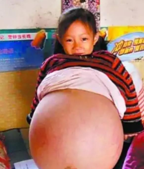 四岁女孩肚子大如孕妇终获救

                         