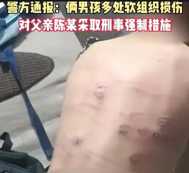 将孩子打成这样，是毫无疑问的虐童，父亲被刑拘一点儿都不冤枉。

不过看网上跟帖，