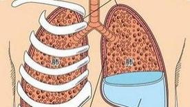 如何快速识别胸腔积液的病因？