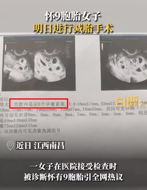 怀9胞胎女子将减去7个胚胎
