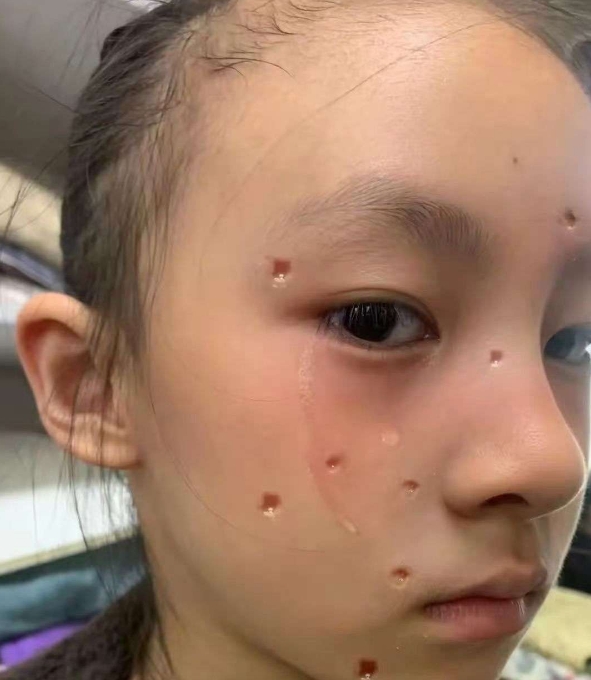 小女孩被妈妈拉去点痣 点完哭的很伤心💔妈妈是糊涂蛋