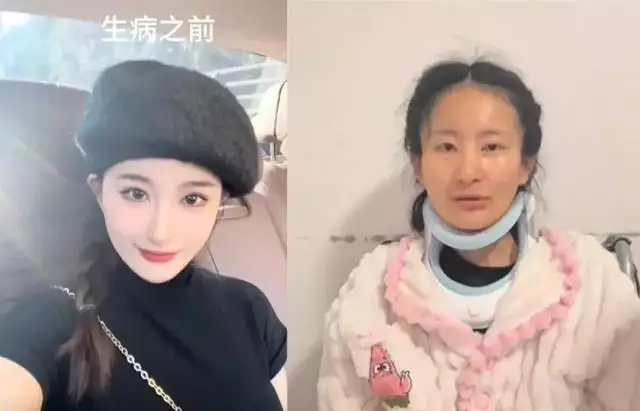 渐冻症一年容貌巨变！