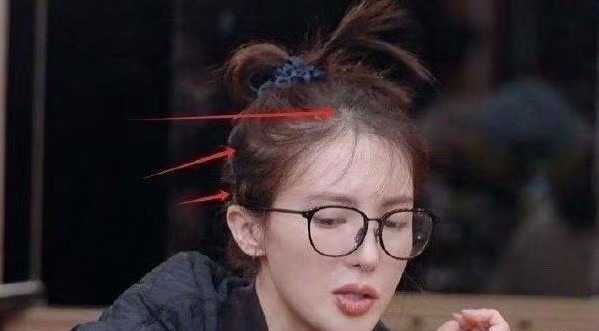 天呐 金晨年纪轻轻就脱发了吗