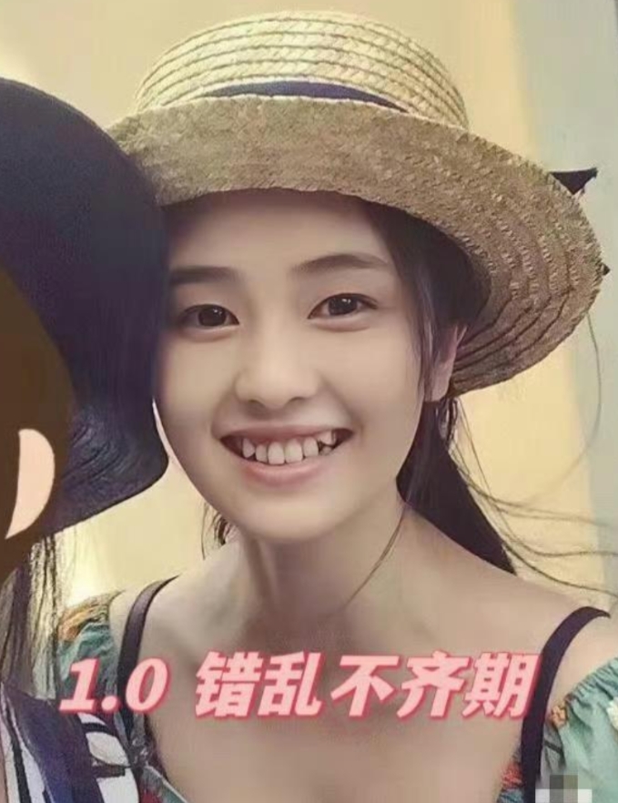 白鹿整牙的三个阶段，难怪都说整牙能达到整容般的效果，确实变化很大。