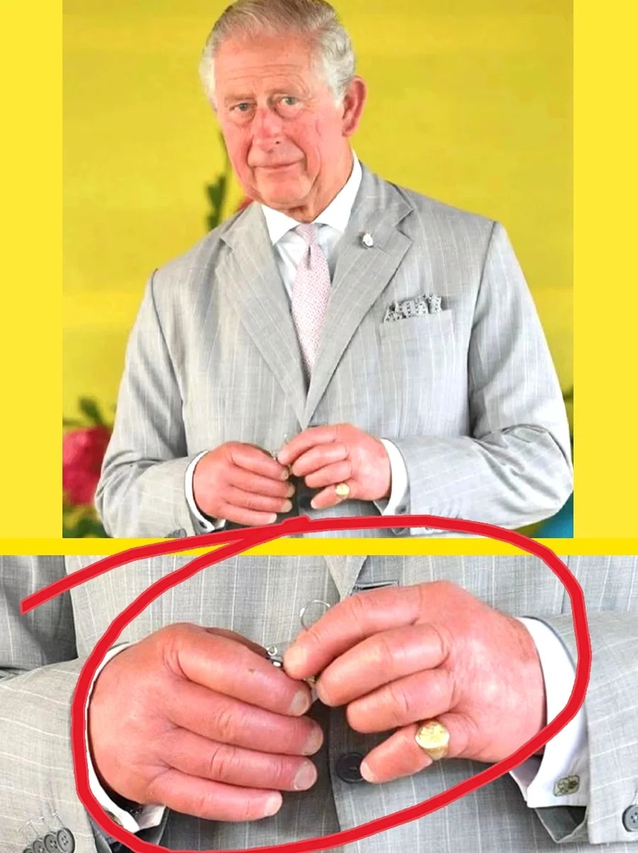 不懂就问？查尔斯王子这手是怎么了？
无意中刷到查尔斯王子
这手也太吓人了吧
什么