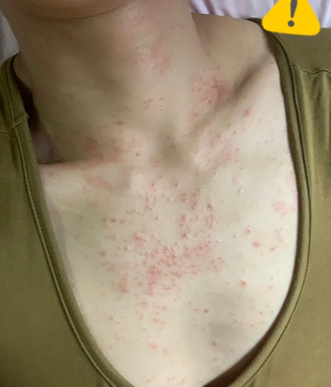 家人们，我真的要被折磨疯了！最近这皮肤病，简直就是我生活里甩不掉的噩梦！

一开