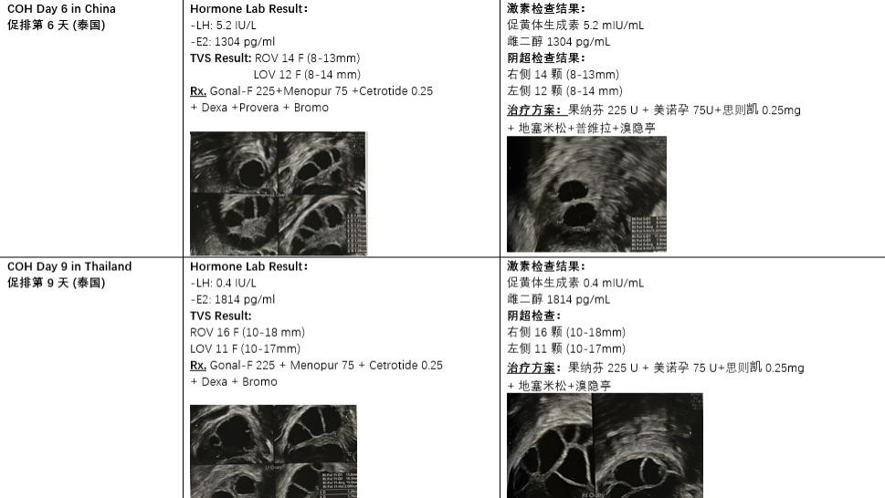 自述：大型子宫瘢痕憩室伴有子宫积水移植成功记！