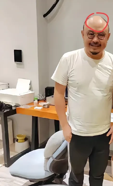刀郎的头顶为啥有个大包，这是咋回事？