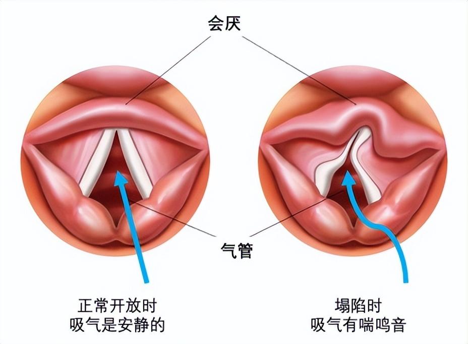 宝宝喉咙有呼噜声, 不一定有痰, 可能是这种病, 严重可能窒息